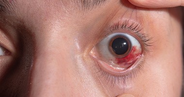 Wylew w oku – przyczyny, diagnostyka i sposoby leczenia pękniętego naczynka w oku