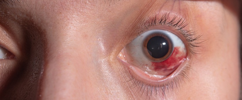 Wylew w oku – przyczyny, diagnostyka i sposoby leczenia pękniętego naczynka w oku