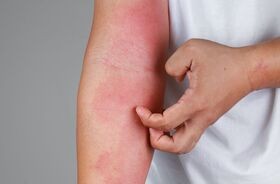 Rumień alergiczny może wystąpić po bezpośrednim kontakcie z alergenem.