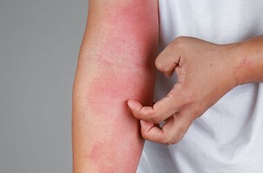 Rumień alergiczny może wystąpić po bezpośrednim kontakcie z alergenem.