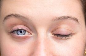 objaw bella, porażenie nerwu twarzowego, 