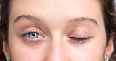 objaw bella, porażenie nerwu twarzowego, 