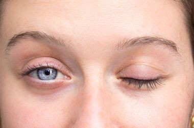 objaw bella, porażenie nerwu twarzowego, 