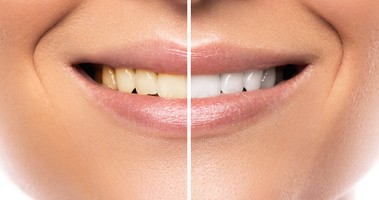 Wybielanie zębów – nowe rodzaje past, nowe metody
