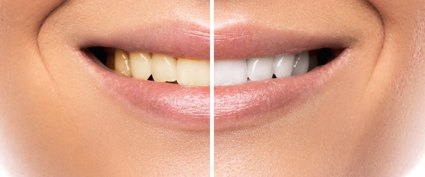 Wybielanie zębów – nowe rodzaje past, nowe metody