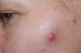 trądzik torbielowaty, trądzik torbielowaty leczenie, torbiel trądzikowa na twarzy kobiety