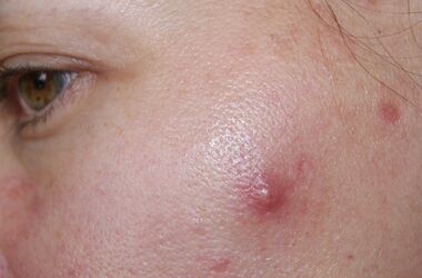 trądzik torbielowaty, trądzik torbielowaty leczenie, torbiel trądzikowa na twarzy kobiety