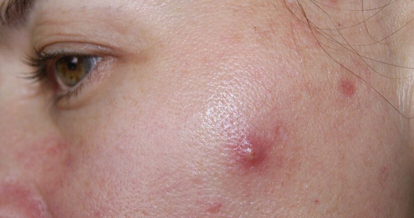 trądzik torbielowaty, trądzik torbielowaty leczenie, torbiel trądzikowa na twarzy kobiety