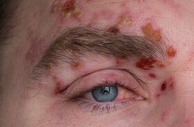 półpasiec oczny, objawy pólpaśca ocznego, mężczyzna z pólpaścem ocznym