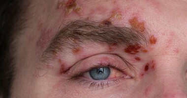 półpasiec oczny, objawy pólpaśca ocznego, mężczyzna z pólpaścem ocznym