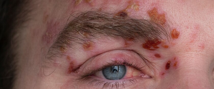 półpasiec oczny, objawy pólpaśca ocznego, mężczyzna z pólpaścem ocznym