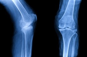 Osteofity stawu kolanowego
