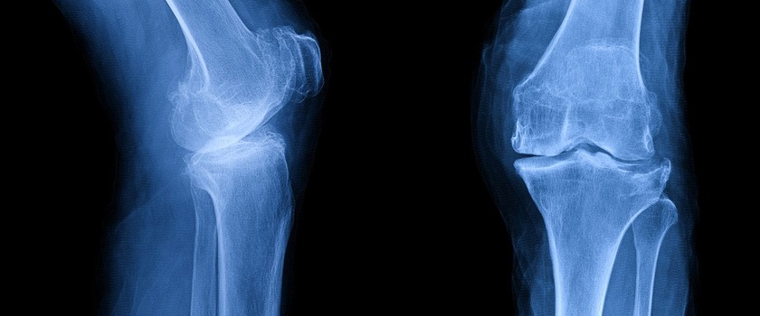 Osteofity stawu kolanowego