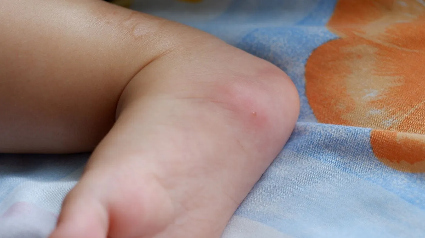 ugryzienie mrówki na nóżce dziecka, jak wygląda ugryzienie mrówki, 	 ugryzienie mrówki zdjęcia