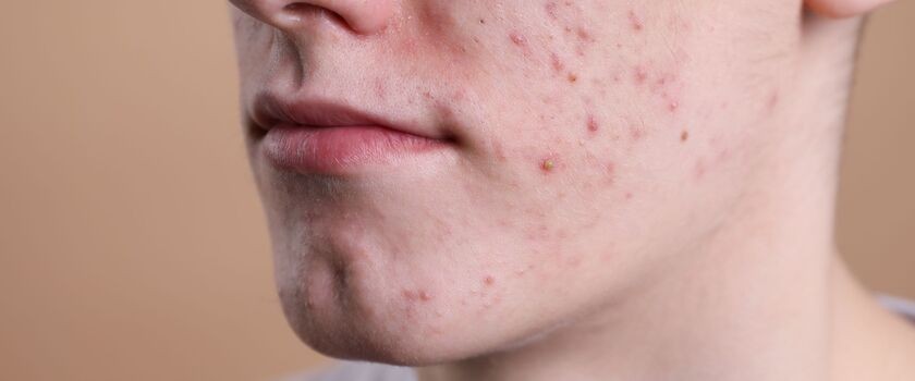 trądzik młodzieńczy, trądzik u nastolatkow, co na trądzik dla nastolatka, chłopiec z trądzikiem