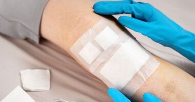 Noga opatrzona plastrami podczas zmiany opatrunku. Jak pielęgnować ranę po operacji, jak dbać o ranę po zabiegu, pielęgnacja rany pooperacyjnej.