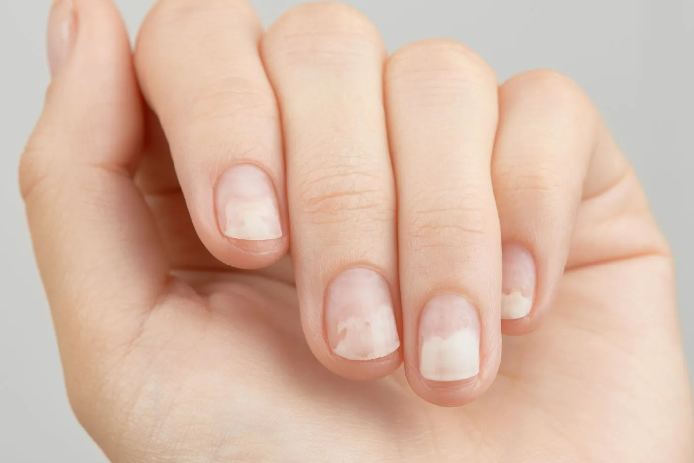 jak wygląda onycholiza paznokci, onycholiza zdjęcia, onycholiza paznokci zdjęcia