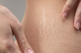 rozstępy, rozstępy na kobiecym brzuchu