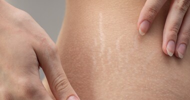 rozstępy, rozstępy na kobiecym brzuchu