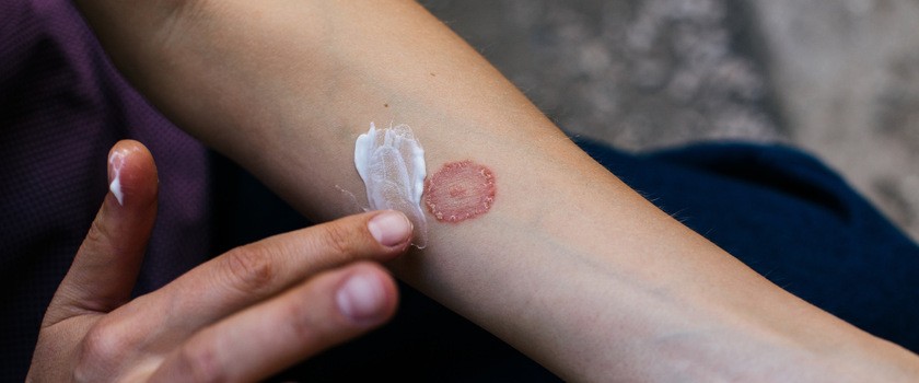 Nakładanie dermokosmetyku na suchą, łuszczącą się skórę u pacjenta z łupieżem pstrym