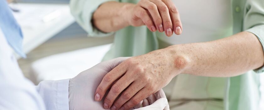 trądzik odwrócony, acne inversa, leczenie trądziku odwróconego