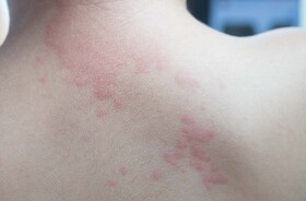 pokrzywka, pokrzywka idiopatyczna, przewlekła pokrzywka, pokrzywka na plechach, pokrzywka u dziecka