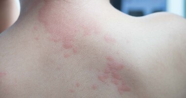 pokrzywka, pokrzywka idiopatyczna, przewlekła pokrzywka, pokrzywka na plechach, pokrzywka u dziecka