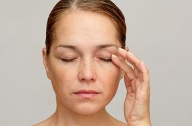 Kobieta dotyka powieki, zakażenie nużeńcem, nużeniec, objawy nużeńca.