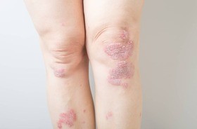 Choroby skóry (dermatozy) – jakie występują najczęściej? Jak je rozpoznać i leczyć?