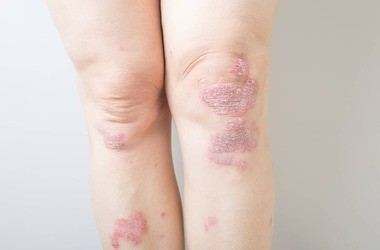 Choroby skóry (dermatozy) – jakie występują najczęściej? Jak je rozpoznać i leczyć?