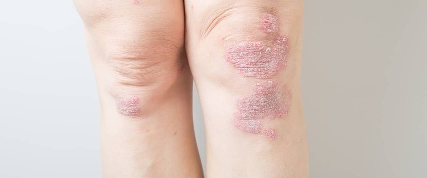 Choroby skóry (dermatozy) – jakie występują najczęściej? Jak je rozpoznać i leczyć?