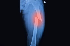 złamanie kości udowej na rentgenie