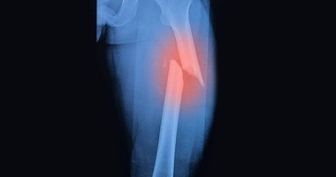 złamanie kości udowej na rentgenie
