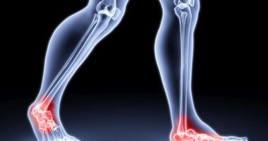 Osteoporoza - przyczyny powstawania, objawy oraz sposoby leczenia