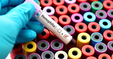 Hemofilia – przyczyny, objawy, leczenie, zalecenia dla chorych