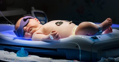 Noworodek z żółtaczka podczas naświetlania lampą UV