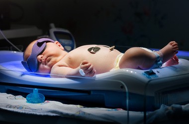Noworodek z żółtaczka podczas naświetlania lampą UV