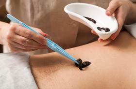 Hirudoterapia – na co pomaga leczenie pijawkami? Wskazania, przeciwwskazania, przebieg zabiegu hirudeterapii