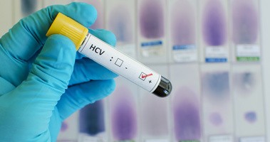 Probówka z krwią, na której jest informacja o dodatnim wyniku badania na obecność anty-HCV