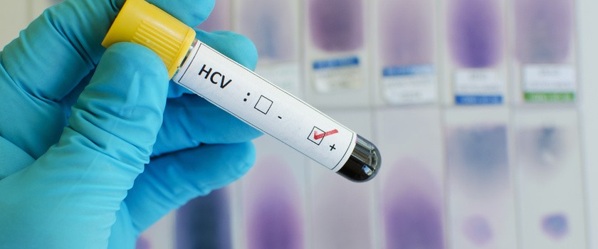 Probówka z krwią, na której jest informacja o dodatnim wyniku badania na obecność anty-HCV