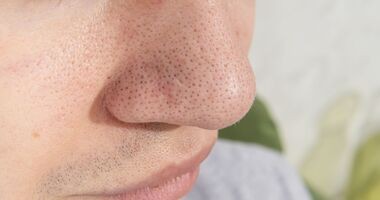 zaskórniki, zaskórniki otwarte, cera trądzikowa, zaskórniki na twarzy mężczyzny