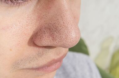 zaskórniki, zaskórniki otwarte, cera trądzikowa, zaskórniki na twarzy mężczyzny