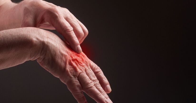 Reumatyzm &#8211; objawy, przyczyny i leczenie