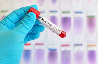 test diagnostyczny na obecnosć wirusa nipah, wirus nipah w Indiach, wirus nipah 2026