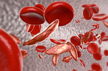 Anemia - objawy, leczenie i dieta