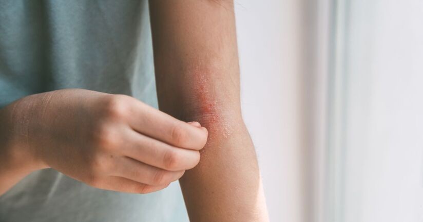 Osoba z atopowym zapaleniem skóry. AZS objawy, objawy atopowego zapalenia skóry.