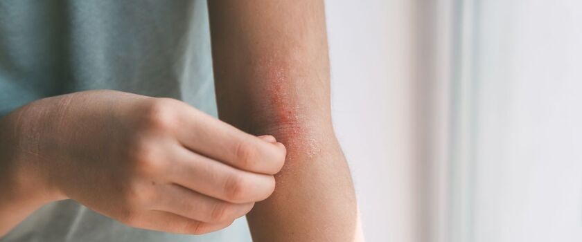 Osoba z atopowym zapaleniem skóry. AZS objawy, objawy atopowego zapalenia skóry.