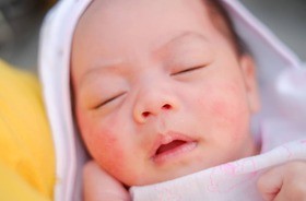 Trądzik niemowlęcy i noworodkowy – charakterystyka i leczenie. Jak pielęgnować skórę trądzikową u malucha?