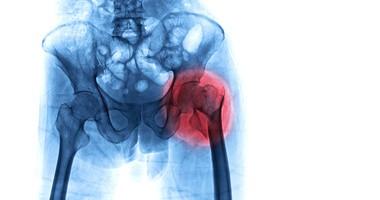 Złamanie szyjki kości udowej – przyczyny, objawy, leczenie operacyjne, rehabilitacja. Powikłania po złamaniu szyjki kości udowej