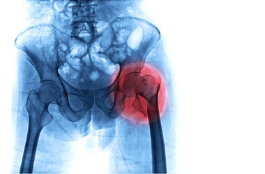 Złamanie szyjki kości udowej – przyczyny, objawy, leczenie operacyjne, rehabilitacja. Powikłania po złamaniu szyjki kości udowej